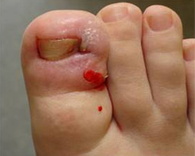 Ingrown toenail