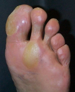 Plantar Fasciitis,Pes Planus,Mallet Toe,High Arched Feet,Heel Spur,Heel Pain,Hammer Toe,Hallux Valgus,Foot Pain,Foot Hard Skin,Foot Conditions,Foot Callous,Flat Feet,Fallen Arches,Diabetic Foot,Contracted Toe,Claw Toe,Bunions Hard Skin,Bunions Callous,Bunion Pain,Ball Of Foot Pain,Back Pain