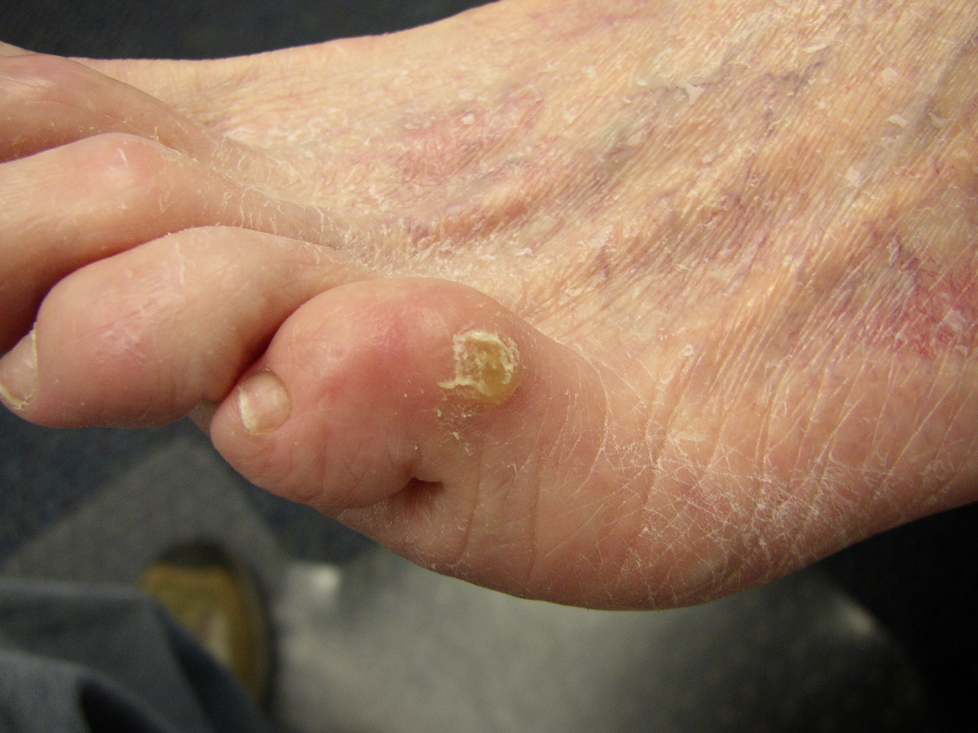 Corns and Calluses. Corn treatment on toes and feet | Patient