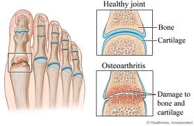 arthritis